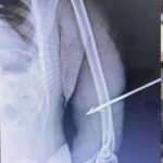 policial federal atingido por flecha em Roraima ferido