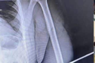 policial federal atingido por flecha em Roraima ferido