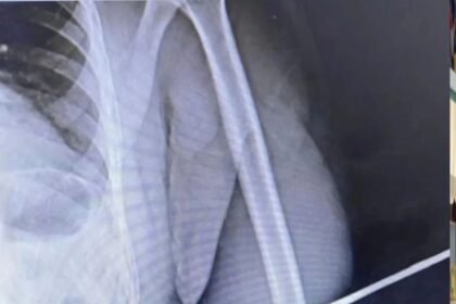 policial federal atingido por flecha em Roraima ferido