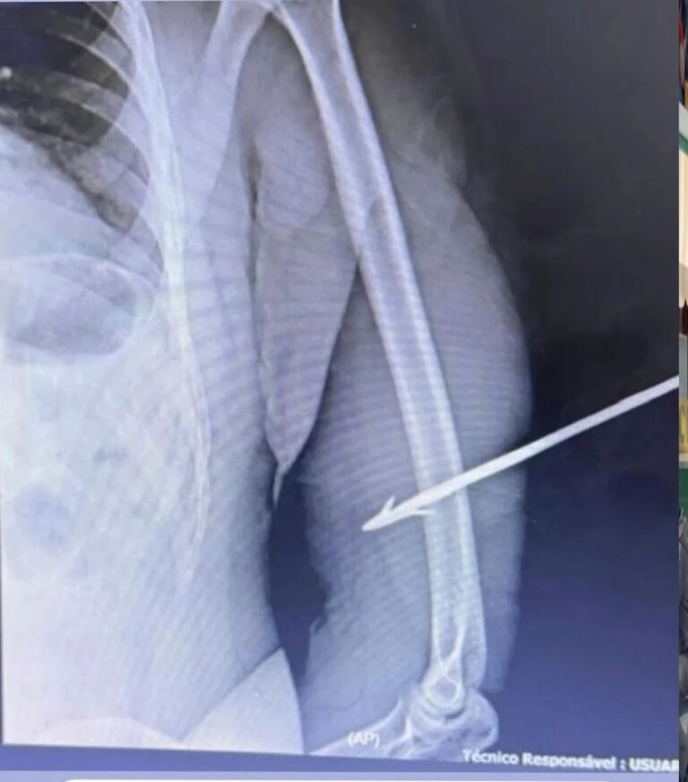 policial federal atingido por flecha em Roraima ferido