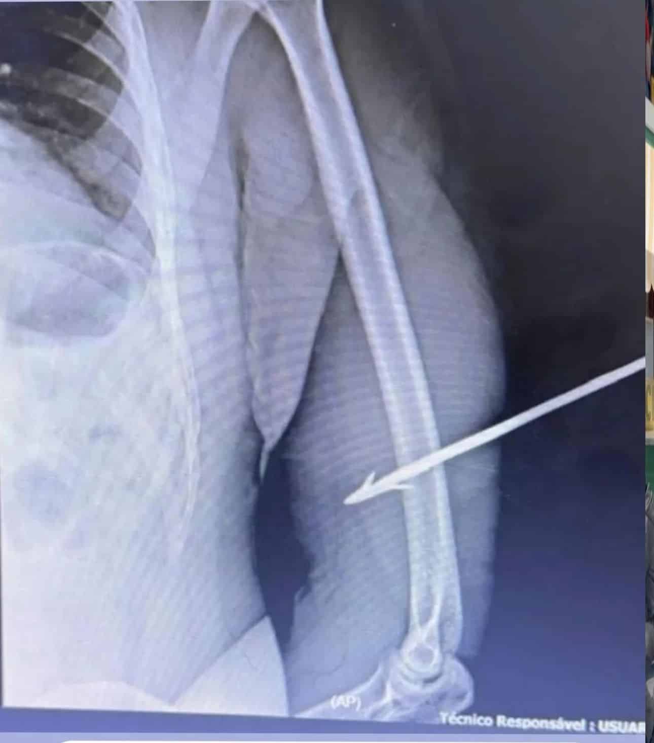 policial federal atingido por flecha em Roraima ferido